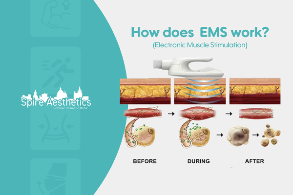 EMS treatment for post pregnancy weight loss treatment Wisbech