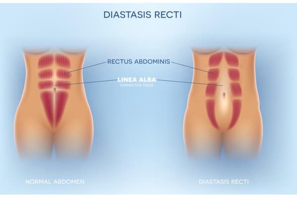 What Non-Surgical Options Are Available for Diastasis Recti Wisbech?