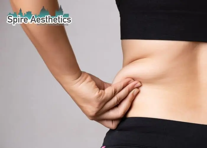 Image of woman pinching fat on their hips Wisbech. Fat Freezing treatment