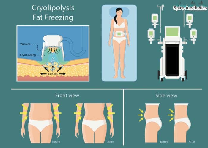 Image of diet and fat freezing combined for best results for Spire Aesthetics Wisbech