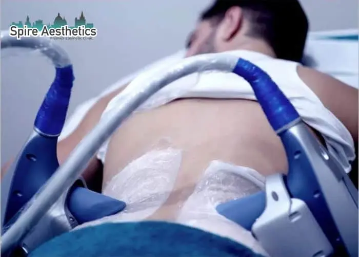 Man having fat freezing treatment done on love handles before a competitions Wisbech to create a sculpted look.