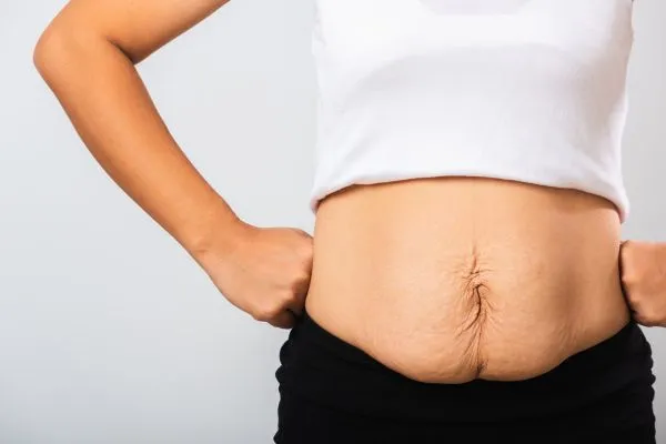 Image of a woman's stomach after weight loss with sagging skin following a gastric band Wisbech