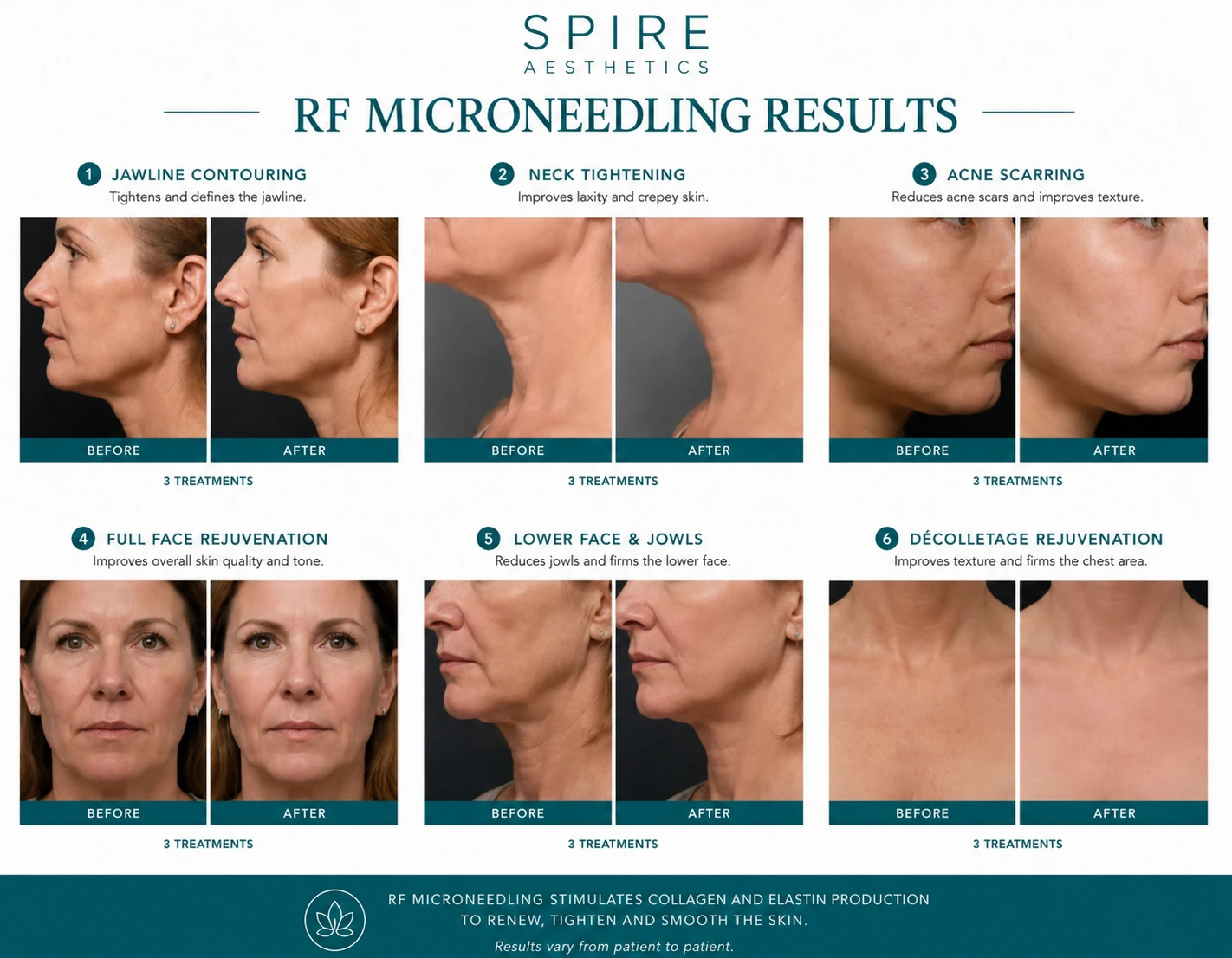 RF Microneedling Skin tightening Wisbech results