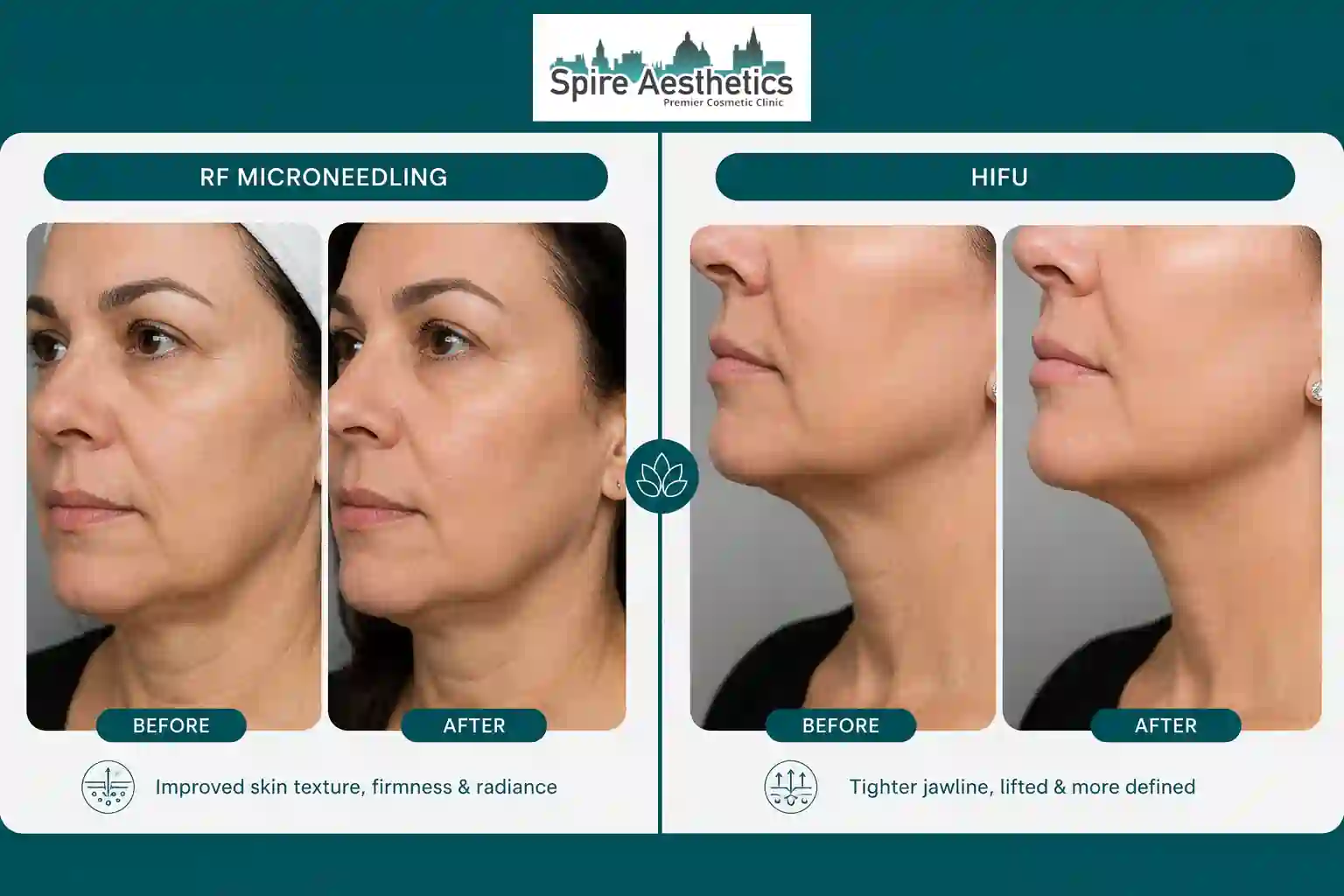 Can RF Microneedling and HIFU Be Combined Wisbech?