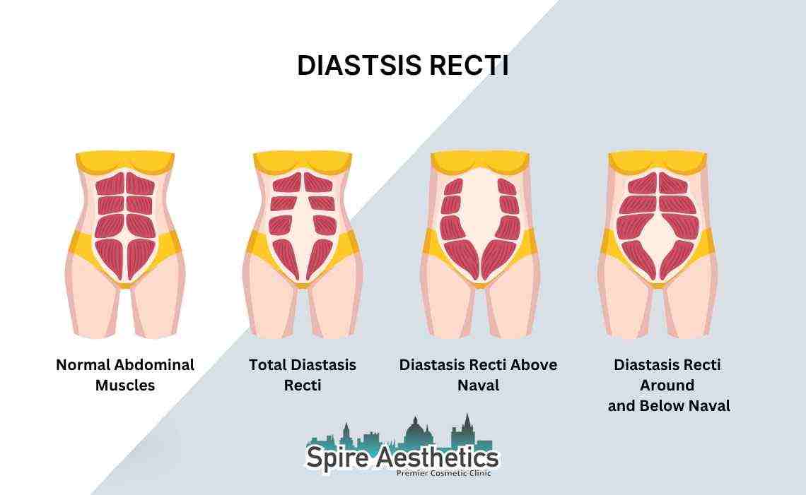 Is Non-Surgical Diastasis Recti Treatment Right for You? Common Concerns Answered Wisbech